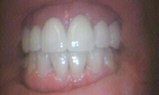 Restored missing teeth with bridges