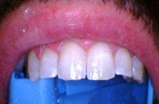 after clear aligners
