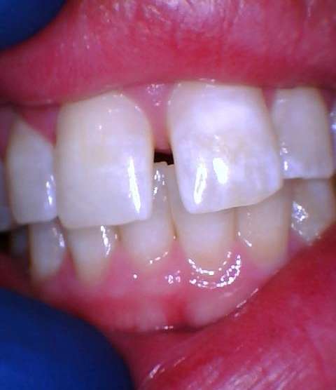 before clear aligners