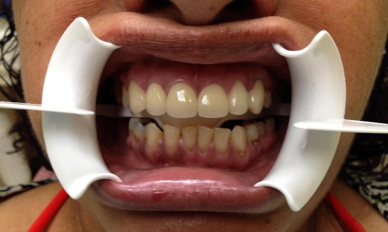 Porcelain-Veneers-After-Image