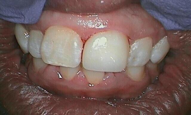 Patient after having tooth replaced with a porcelain veneer. 