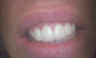 Patient after having teeth replaced with a porcelain veneers.