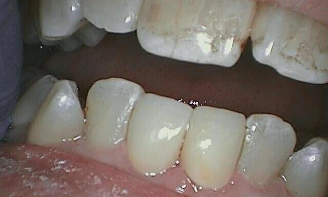 Patient after having teeth replaced with a porcelain veneer. 
