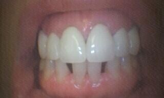 Restored missing teeth with bridges