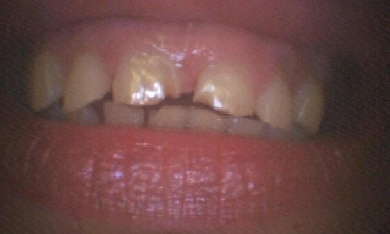 Porcelain-Veneers-Before-Image