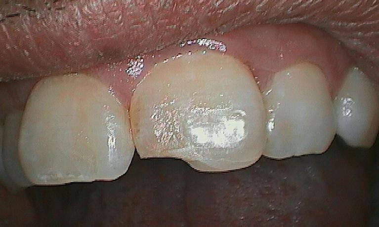 Patient before having tooth replaced with a porcelain veneer.