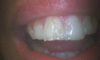 Patient before teeth were restored with porcelain veneers.