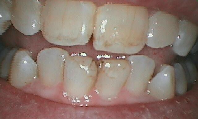 Patient before chipped teeth were restored with porcelain veneers.