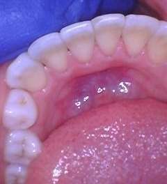 Clear-Aligners-After-Image