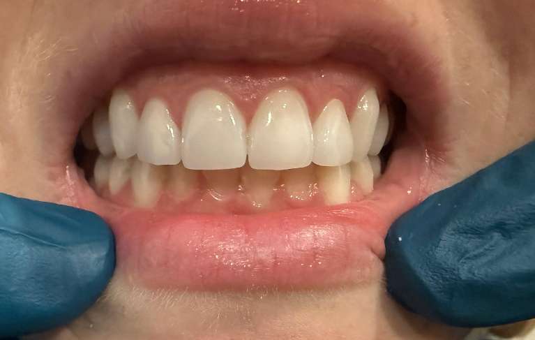Veneers-After-Image