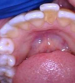 Clear-Aligners-Before-Image