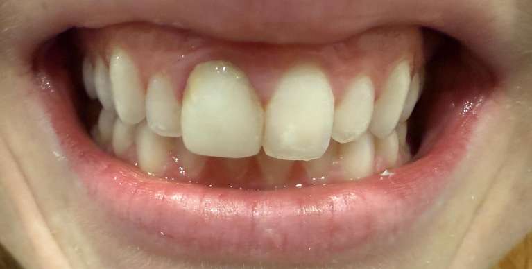 Veneers-Before-Image